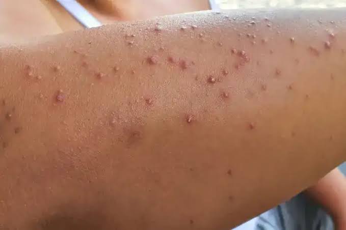 Sırt ve kol bölgesindeki akne benzeri kabarıklıklar ile ton farklılıklarını gösteren örnek cilt fotoğrafı